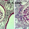 Aspecto histológico de una glomerulonefritis mesangial secundaria a la leishmaniosis canina